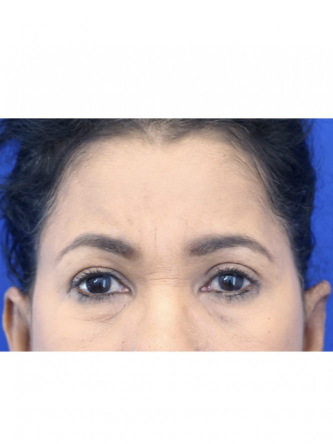 Endoscopic Forehead Lift — After