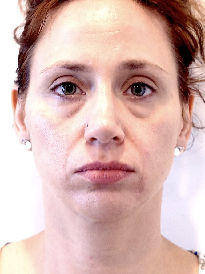Under Eye Filling — Before