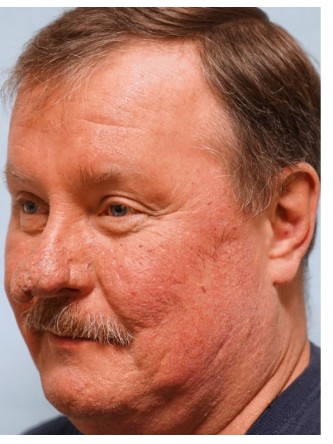 Rhinophyma* — Before