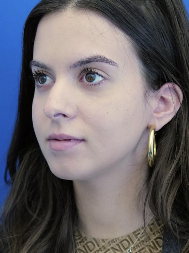 Preservation Rhinoplasty2 — Before