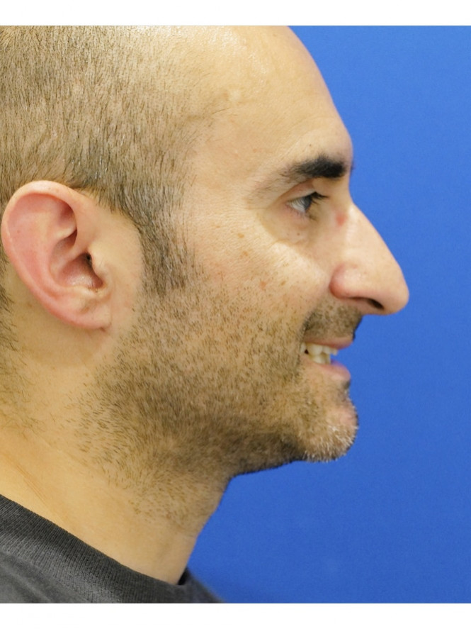 Tension Tip Ptosis — Before