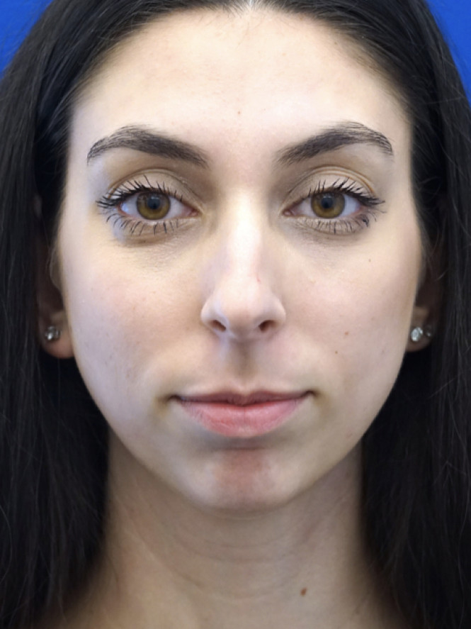 Facial Profile Balance — Before