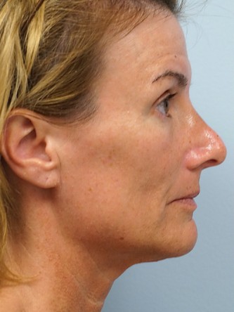 Voluma to Malar Cheek* — Before