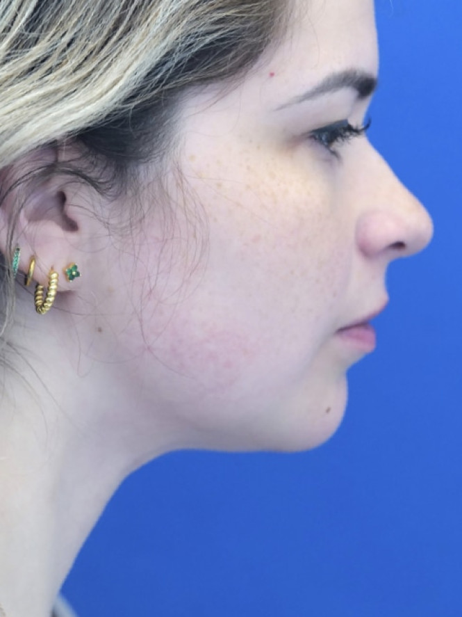 Underchin Fullness — After