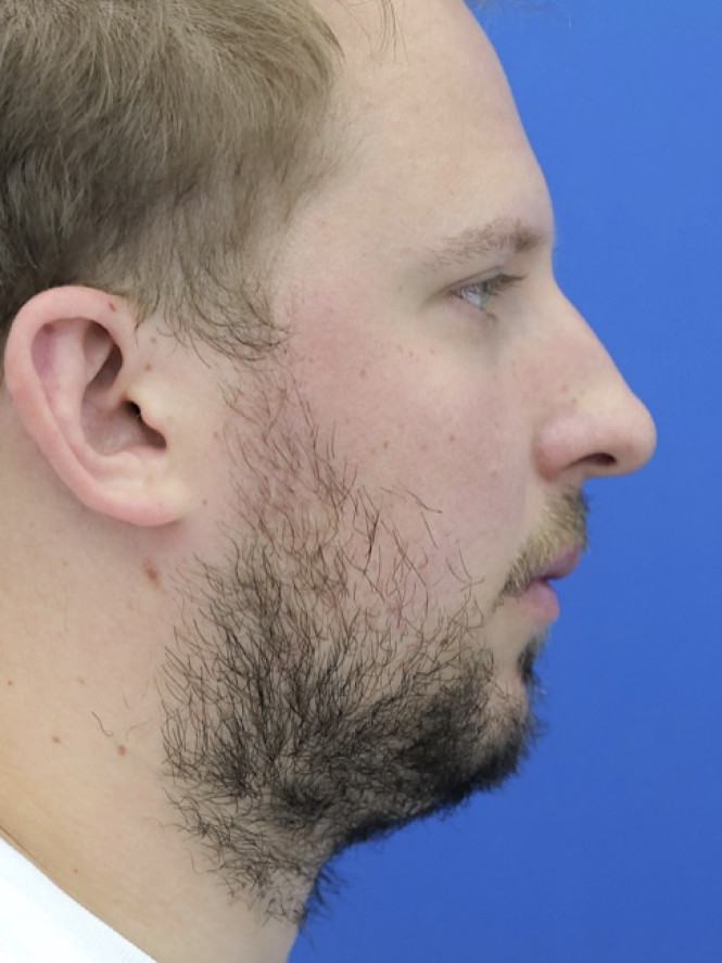 Dorsal Hump and Chin Augmentation — Before