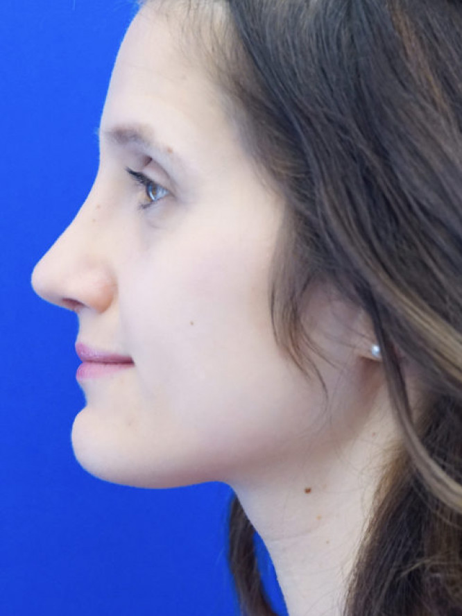 Nasal Profile Bliss — After