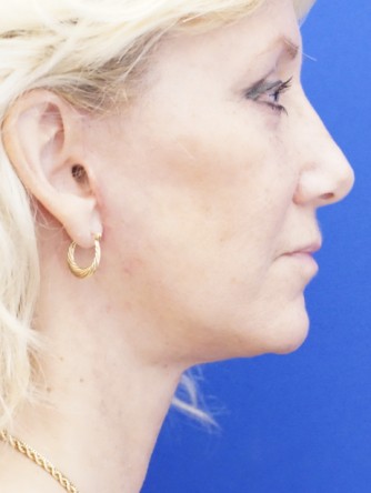 Facelift, Eyelid Skin Trim, Facial Fat Transfer* — After