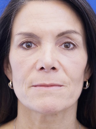 Nasal Tip Deformity — After