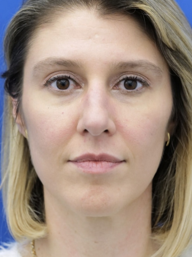Dorsal Hump and Finesse Tip — Before