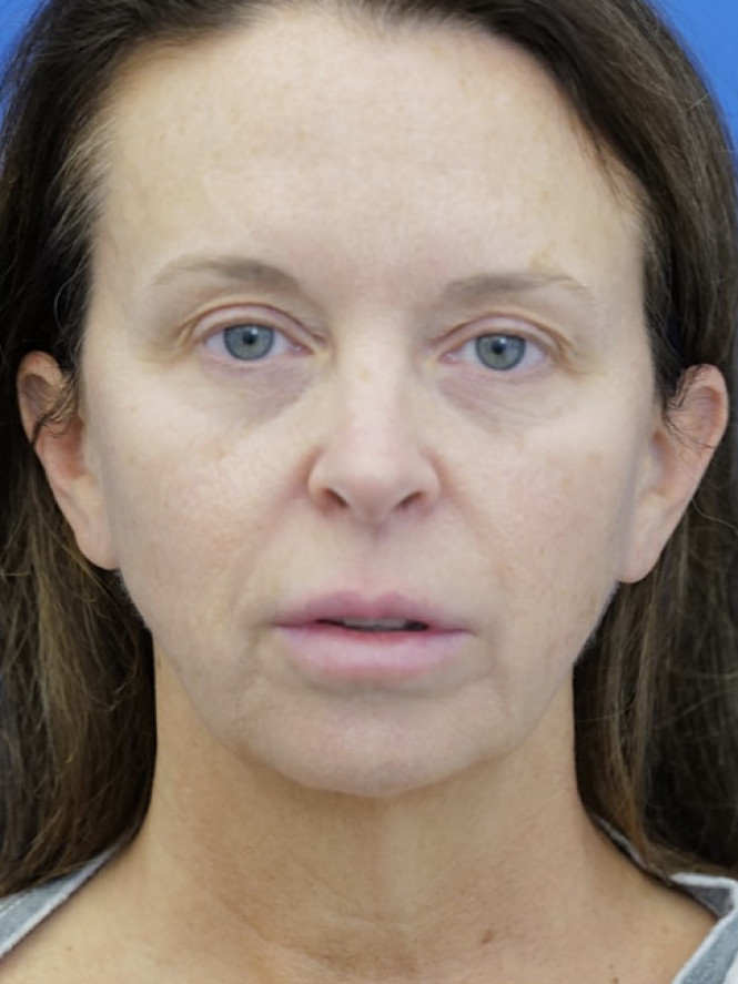 Jowling and Skin Laxity — Before