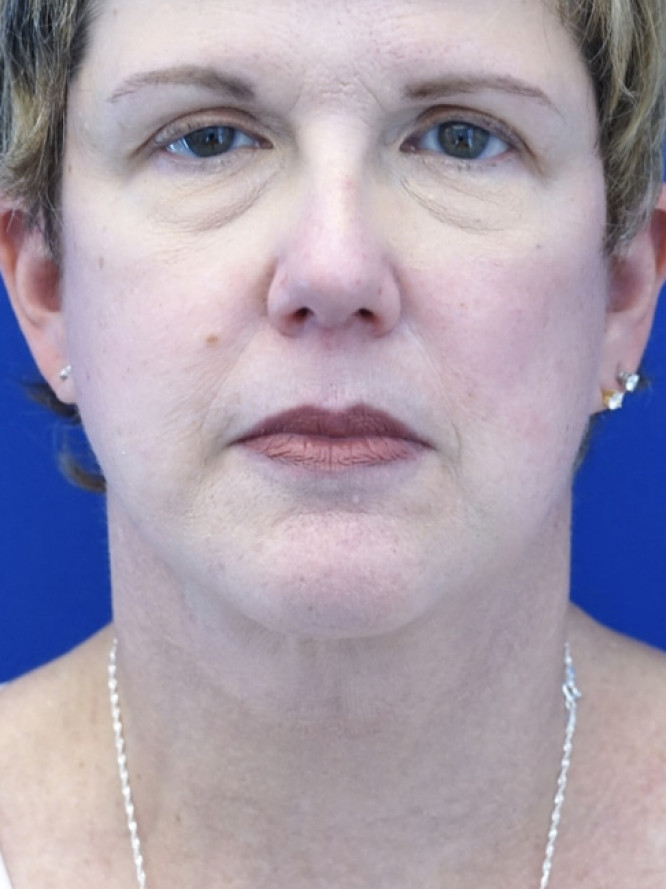 Facelift Platysmaplasty with Subplatysmal Lipectomy — After