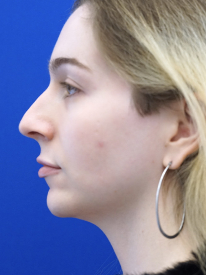 Soften Nasal Contour — Before