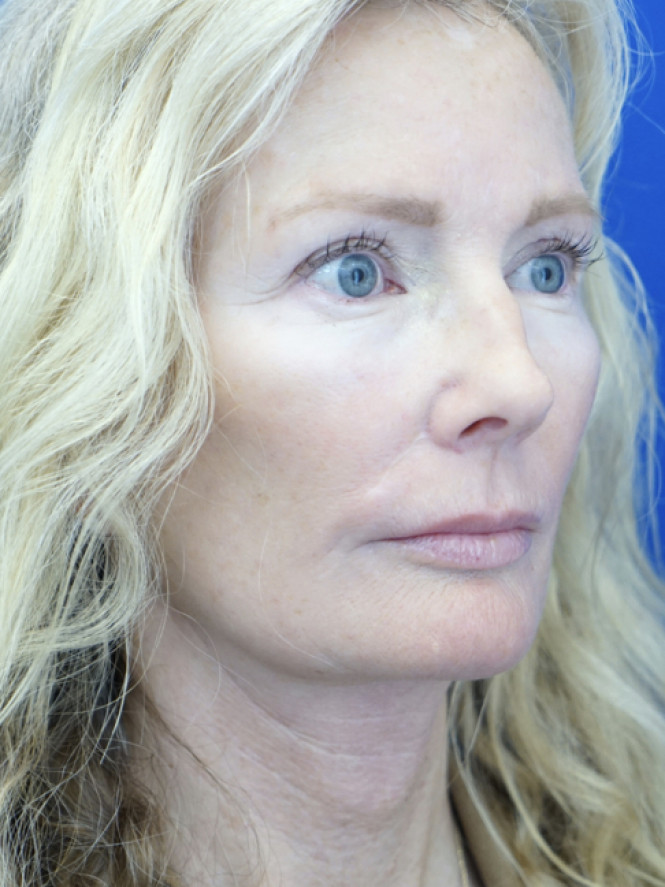 Scintillating Natural Result — After