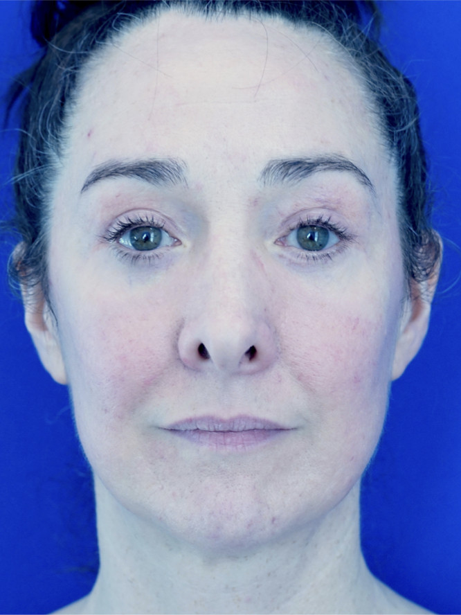 Quad Eyelid Blepharoplasty with Fat Reposition — After