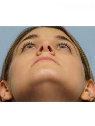 Droopy Tip Endonasal Rhinoplasty* — After