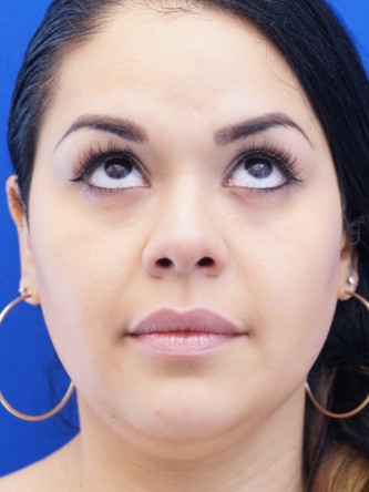 Twin Tear Trough Fillers* — Before