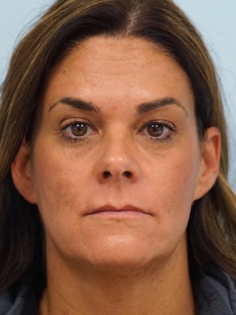 Glabellar Botox and Filler* — After