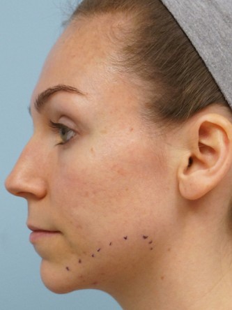 Fractional CO2 Laser Skin Resurfacing1* — Before