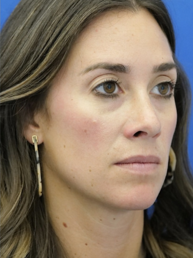 Preservation Rhinoplasty — After