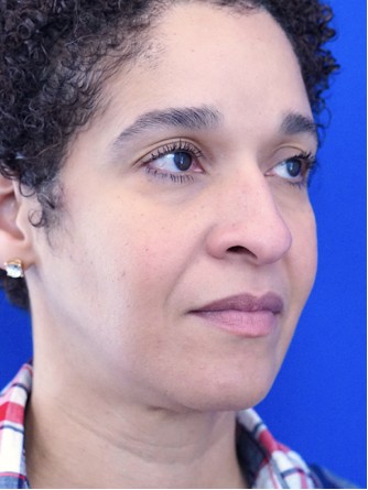Ethnic Rhinoplasty* — Before