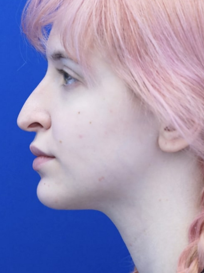 Long Droopy Tip — Before