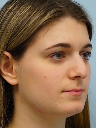 Droopy Tip Endonasal Rhinoplasty* — Before