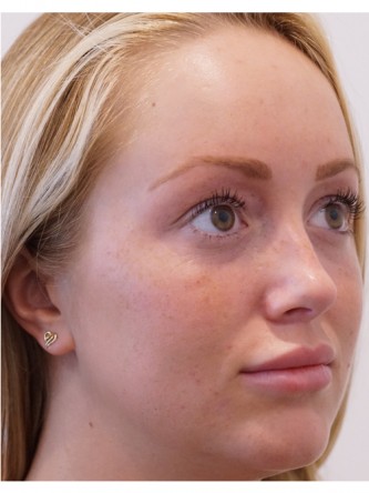 Restylane Silk to Upper & Lower Lips* — After
