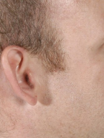 Protruding Ears – Moderate* — Before
