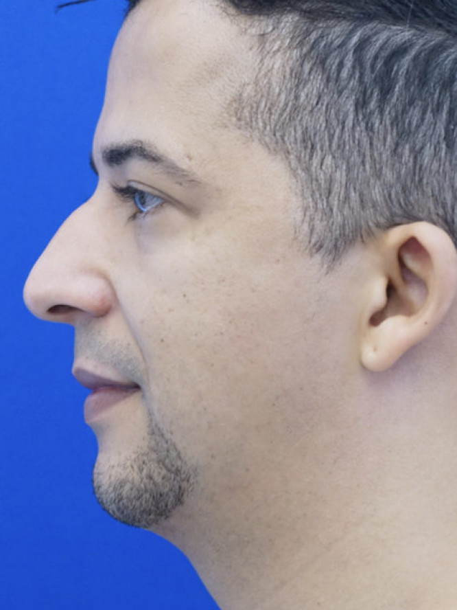 Endonasal Hump Removal — Before