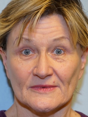 Endoscopic Browlift & Upper Eyelid Droop* — After