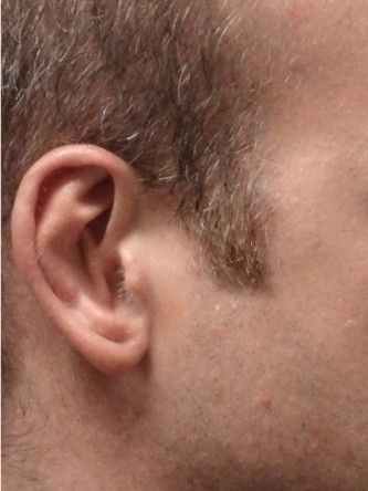Protruding Ears – Moderate* — After