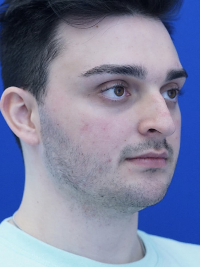 Profile Enhancement — Before