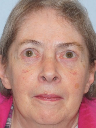 Visual Field Deficit – Eyelid Ptosis3* — After