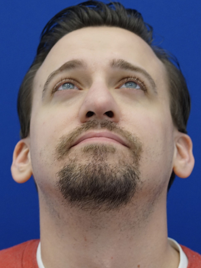 Crooked Thick Skin Nose — After