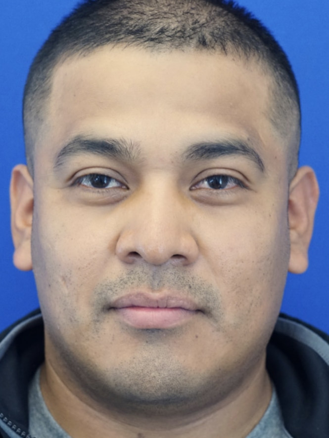 Rhinoplasty Trifecta — Before