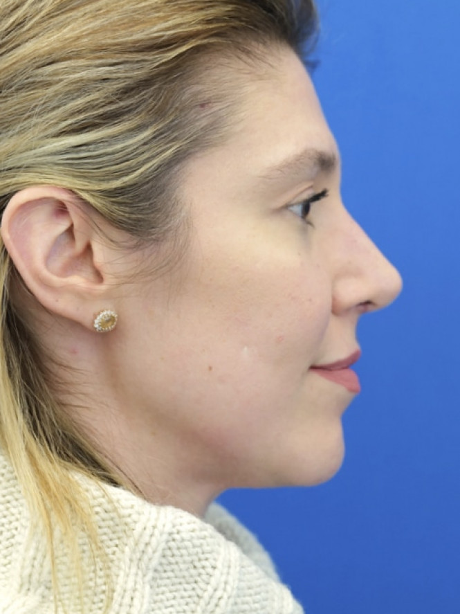 Dorsal Hump and Finesse Tip — After