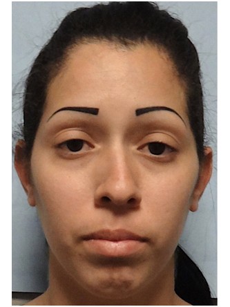 Nasal Obstruction – Crooked Nose2* — Before