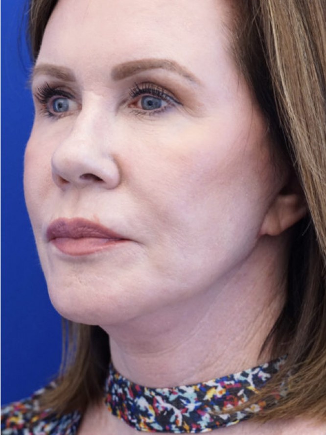 Secondary Lift and Facial Fat Grafting — After