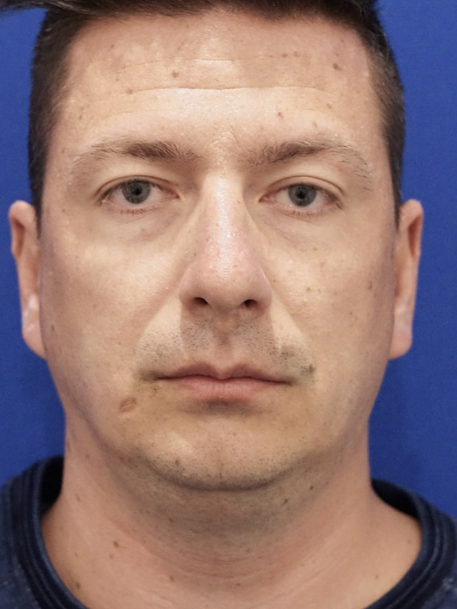 Vertical Lengthening Chin Augmentation — Before