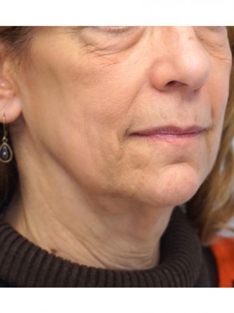 Full Face and Necklift, Upper and Lower Eyelid, Browlift* — Before