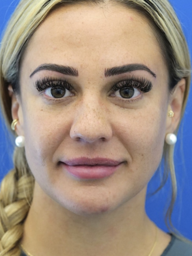 Lower Facial Rejuvenation — After