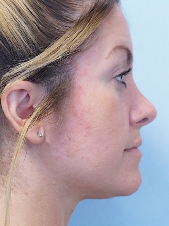 Boxy Tip Endonasal Rhinoplasty* — After
