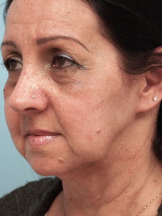 Aging Eyelid Rejuvenation, Facelift, Necklift 2* — Before