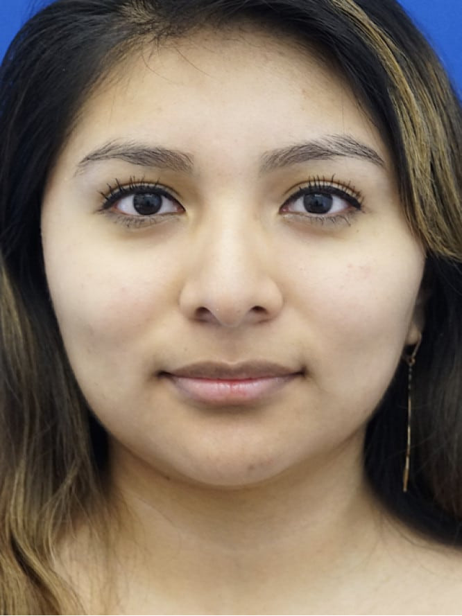 Droopy Nasal Tip — Before