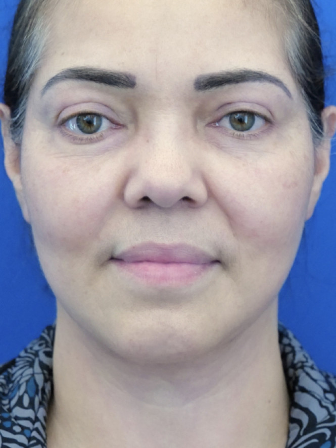 Deep Plane 2 Years Result — After