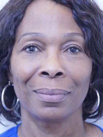 Tear Trough Under Eye Enhancement — After