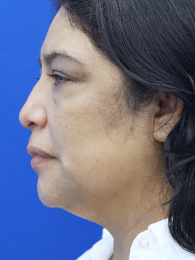 Four-Lid Blepharoplasty — Before