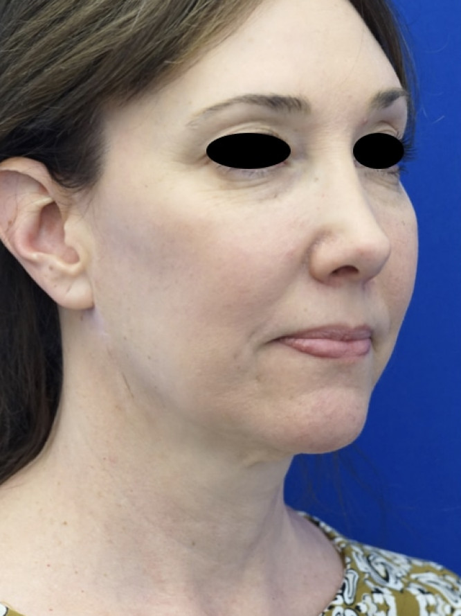 Secondary Deep Plane Lift with Scar Revision — Before