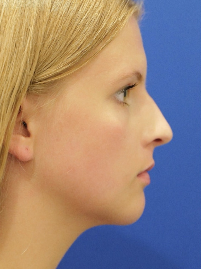 Soften Nasal Appearance — Before