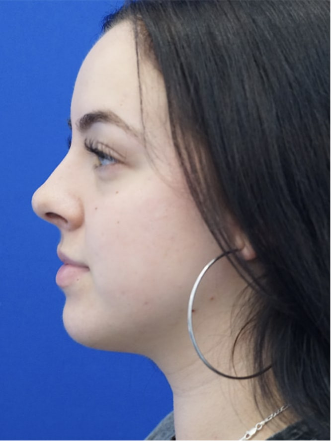 Scarless Hump Reduction — After